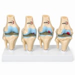4 Stages of Knee Joint Diseases